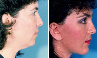 Cheek Lift and Augmentation before 296648