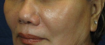 Cheek Lift / Augmentation after 352885