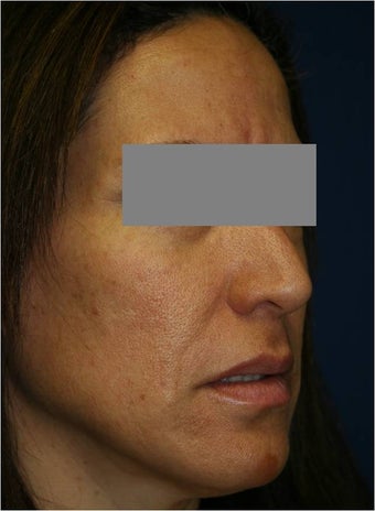 47 year old female treated for melasma, age spots, large pores and rough skin texture 645449