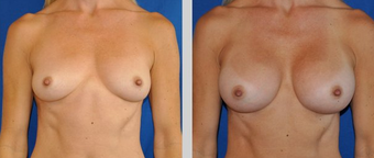 Flash Recovery Breast Augmentation TM before 253914