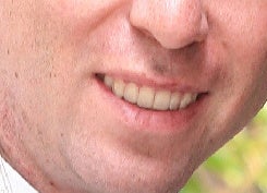 Invisalign after 109163