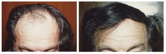 Hair Transplant before 369161