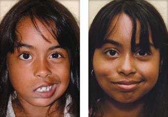 Facial Paralysis and Reconstruction before 346225