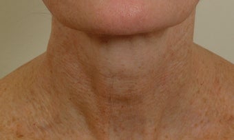 Pearl Laser Treatment before 102784