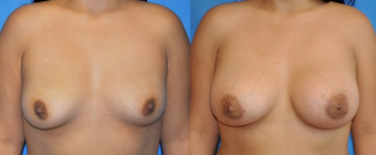 Flash Recovery Breast Augmentation TM before 253901