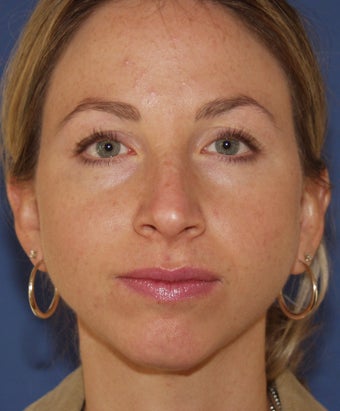 Chin Implant before 414149