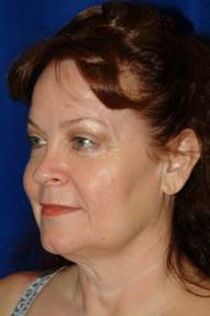 Fascial fat grafting with facelift before 76008