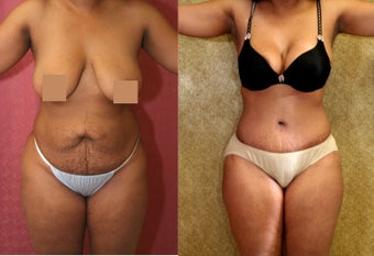 tummy tuck after 304680