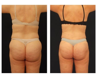 Liposuction before 286738