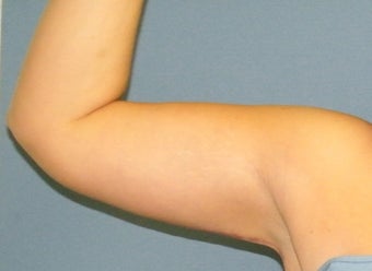 Brachioplasty after 560843