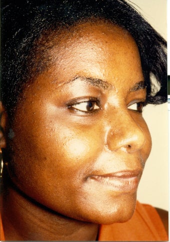 Rhinoplasty after 383006