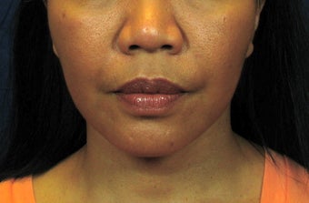 Chin Implant with Laser Facelift after 342973