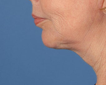 Chin Implant after 504101