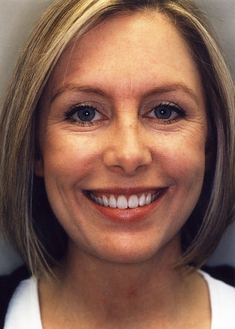 Botox before 628888