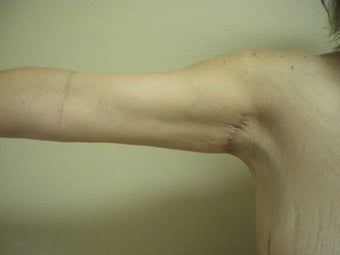 Arm Lift after 155759