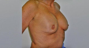 Implant Correction 494513