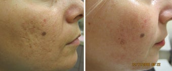 Fractional Resurfacing Acne Scars before 315014