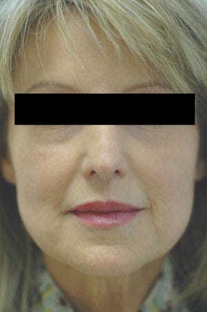 Laugh Lines with Juvederm in Anaheim, CA before 204771