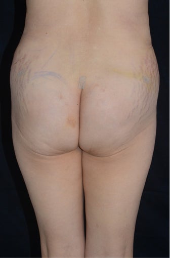 Liposuction and Abdominoplasty after 555498
