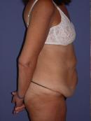 Body Lift 329945
