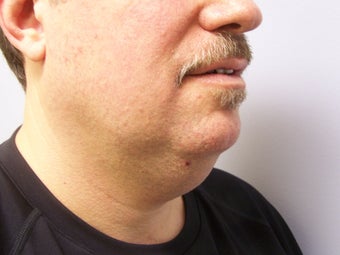 Chin/Neck Liposuction 593084