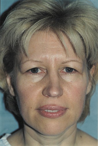 Browlift before 233637