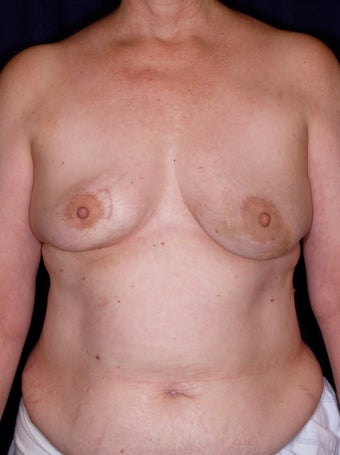 DIEP Flap Breast Reconstruction before 523524