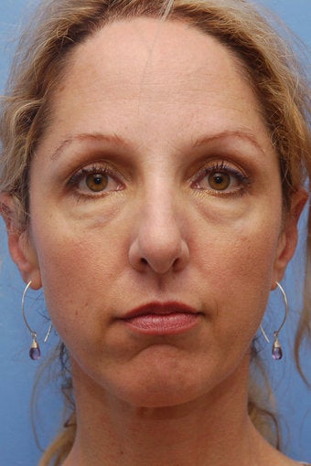 Cheek Dermafillers, Eye Dermafillers, Facial Dermafillers before 441943