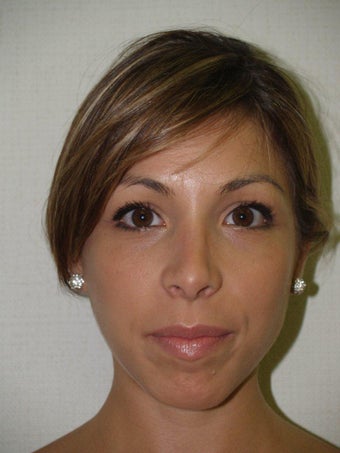 Rhinoplasty after 214513