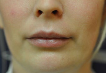 Lip Augmentation with Filler after 560211
