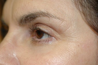 CO2 Laser resurfacing after 341479
