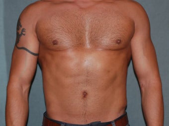 Liposculpting of the abdomen after 319829