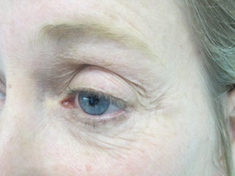 Portrait Plasma Resurfacing before 580576