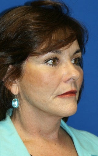 1 month pot-op: Facelift, Necklift, Neck Liposuction, Fat Transfer, and Browlift after 424191
