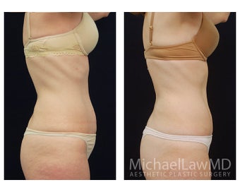 Abdominoplasty - Tummy Tuck 396013