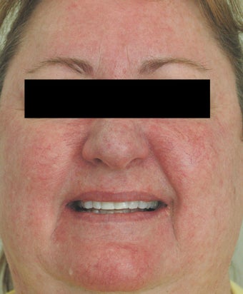 Rosacea Laser Treatment Los Angeles Before and After Pictures before 411345