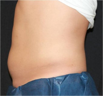 CoolSculpting before 421630