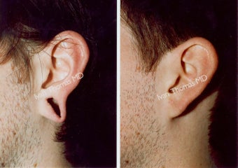 Earlobe Surgery before 243336