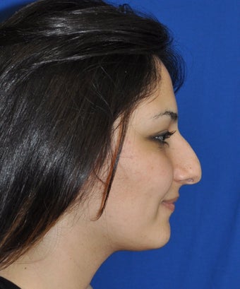 Rhinoplasty before 374395