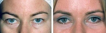Blepharoplasty before 643214
