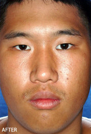 Rhinoplasty after 319071