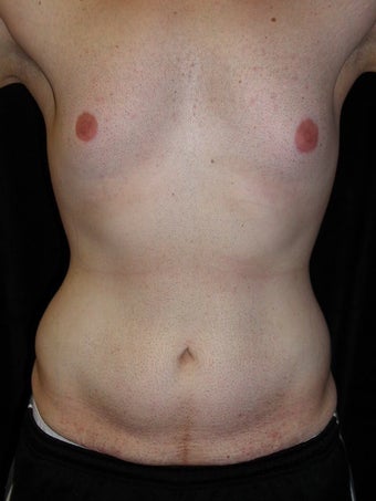Male Tummy Tuck, Flank Liposuction, Male Breast Reduction before 578191