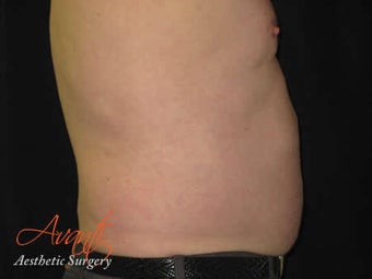 Vaser Lipo - Abdomen after 376426