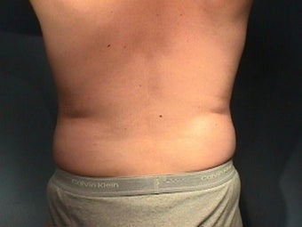 Liposuction before 140076