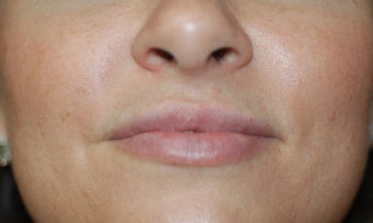 Juvederm Lip Augmentation after 624796
