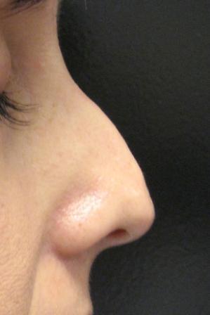 Nasal Tip created using Radiesse before 152209