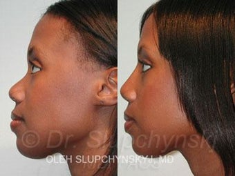 African American Rhinoplasty before 374015