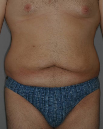Male Abdominoplasty before 586638