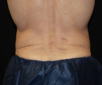 CoolSculpting on love handle and flank areas after 482900