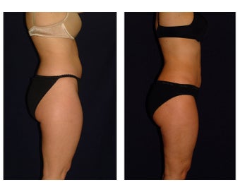 Liposuction before 286646